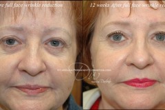 Wrinkle reduction, anti wrinkle, dry needling, needle wrinkles, Concord, NC. Charlotte, NC. Anti aging. Permanent makeup. Permanent eyebrows, permanent eyeliner, permanent lip color, 3d eyebrows, microblading. Medical tattooing. 3d areola nipple tattoo.