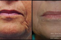 wrinkle-reduction-2-e1470167191911