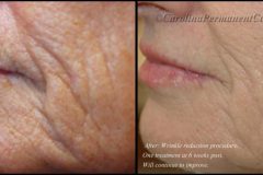 wrinkle-reduction-e1470167169890